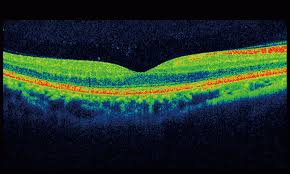 OCT Scan of healthy eye
