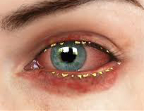 Eye with blepharitis
