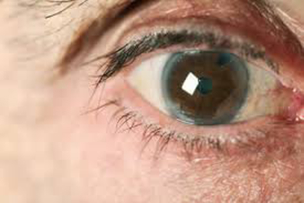 eye with glaucoma image