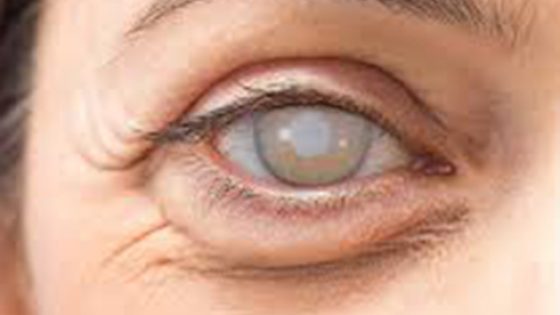 cataracts Eye with cataracts